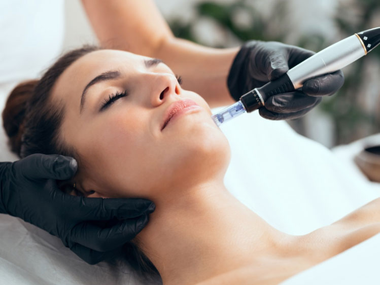 Microneedling